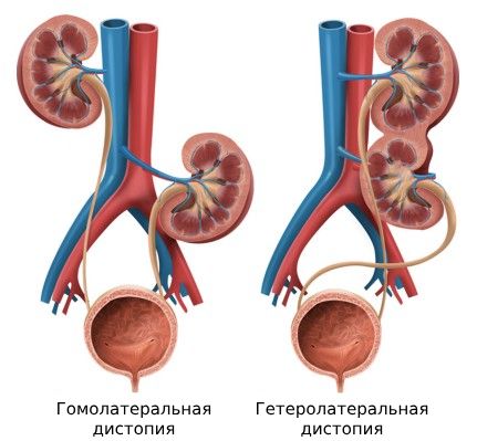 Гомолатеральная и гетеролатеральная дистопия