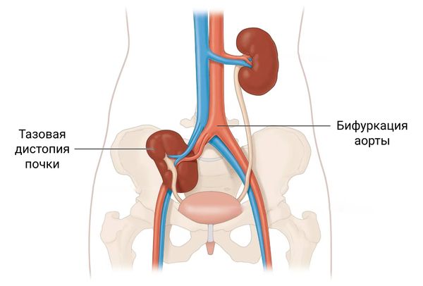Бифуркация аорты