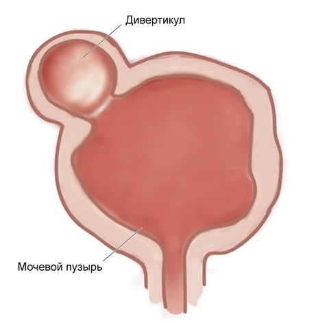 Дивертикул мочевого пузыря