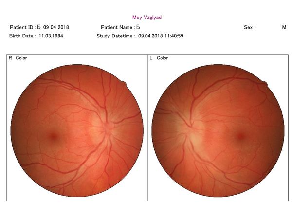 Фото глазного дна через 2 недели