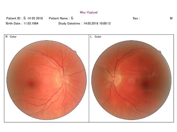 Фото глазного дна через месяц