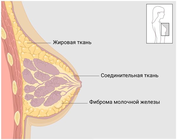 Фиброма молочной железы