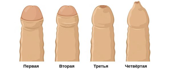 Степени тяжести фимоза