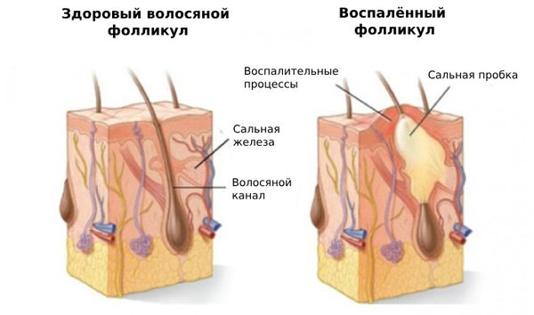 Воспалённый фолликул