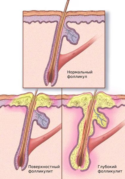 Поверхностный и глубокий фолликулит