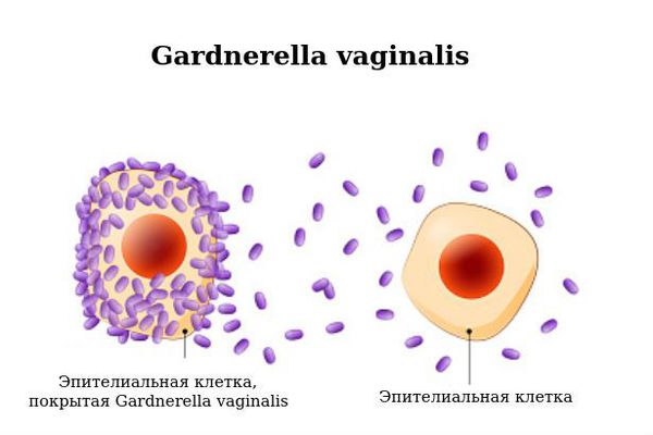 Gardnerella vaginalis