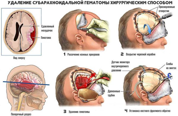 Хирургическое удаление гематомы