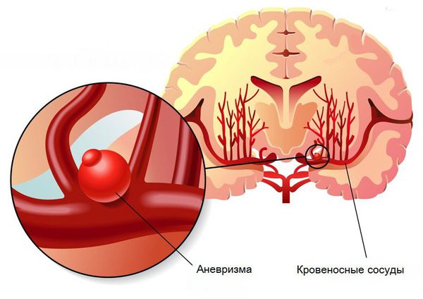 Аневризма головного мозга