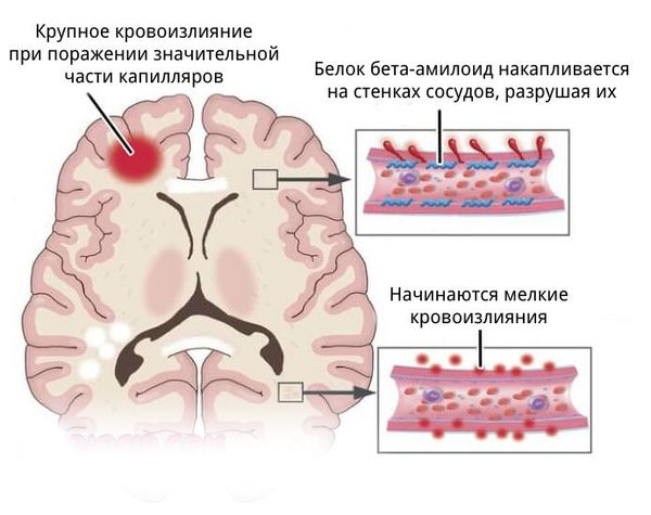 Амилоидная ангиопатия