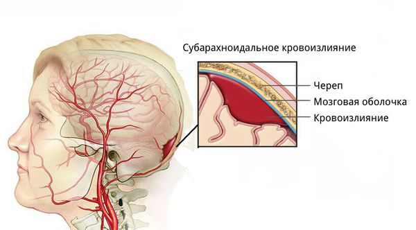 Кровоизлияние в субарахноидальное пространство