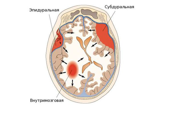 Виды гематом