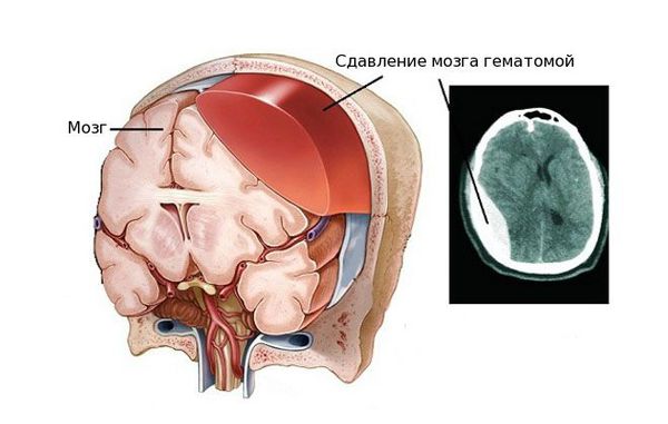 Сдавление мозга гематомой