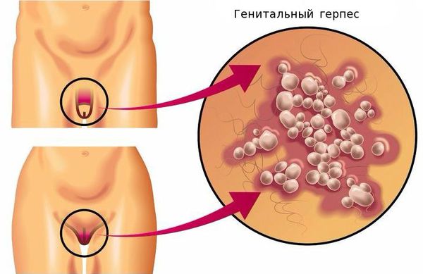 Генитальный герпес