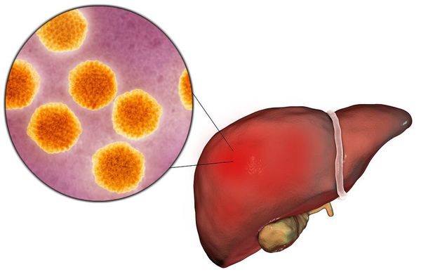 Поражение печени вирусом гепатита А