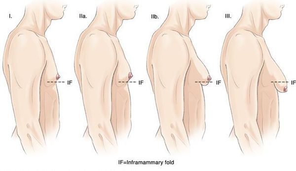 Степени гинекомастии