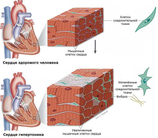 Увеличение миокарда при гипертонии