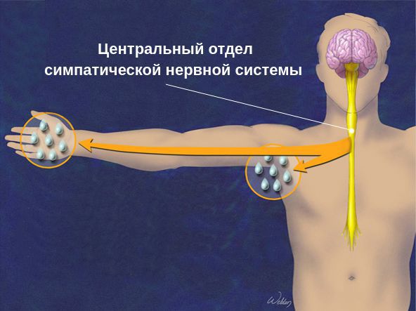 Потоотделение при гипергидрозе