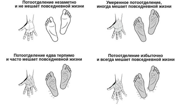 Степени выраженности гипергидроза