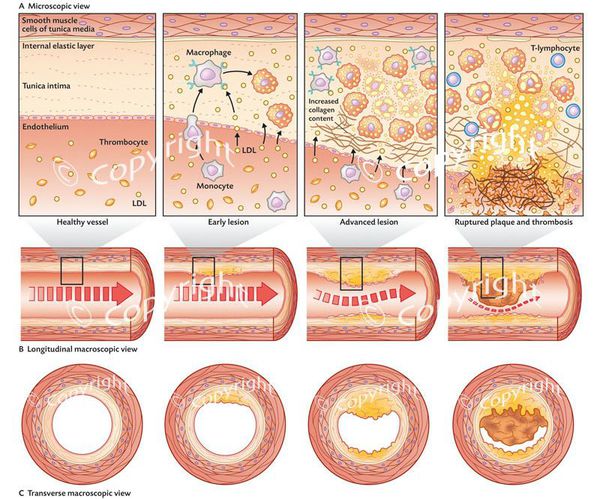 Формирование атеросклеротических бляшек и тромба