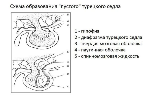 Синдром "пустого турецкого седла"