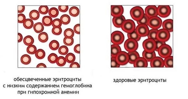 Эритроциты в норме и при гипохромной анемии