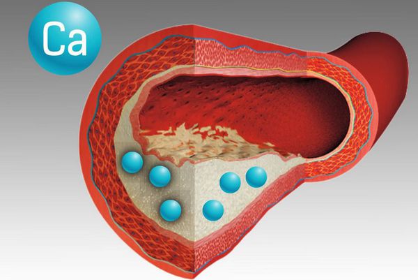 Отложения кальция в сосудах