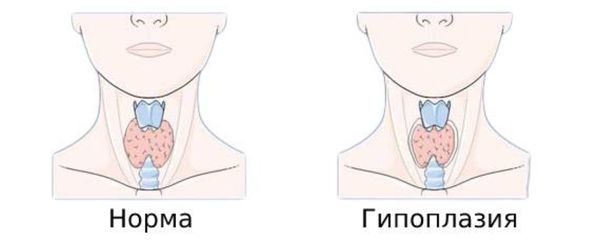Щитовидная железа в норме и при гипоплазии