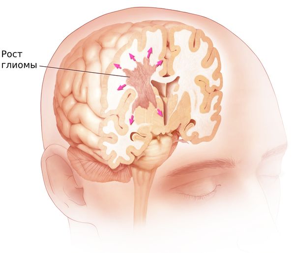 Глиальная опухоль головного мозга