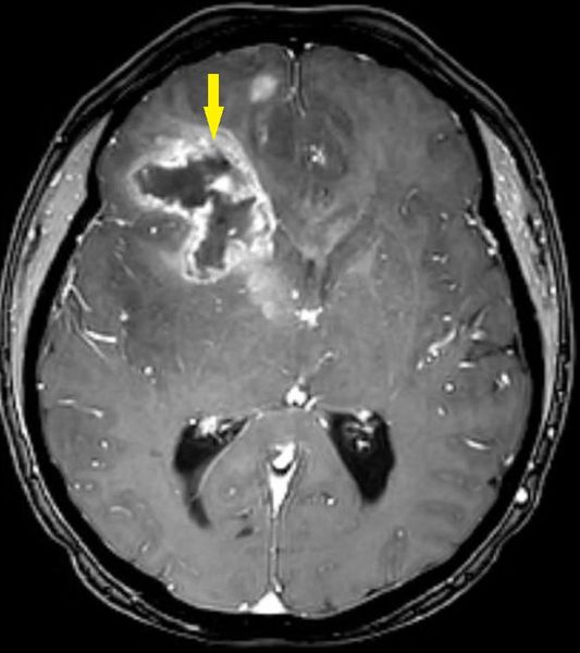 Глиобластома на МРТ головного мозга 