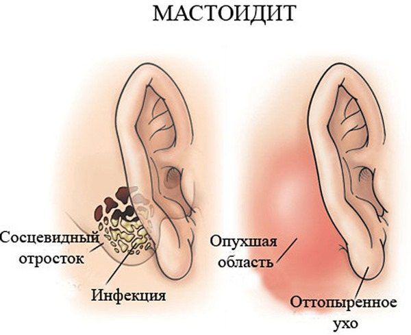 Мастоидит