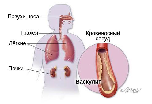 Органы-мишени при гранулематозе Вегенера