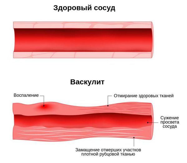 Поражение сосуда при васкулите