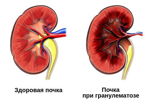 Поражение почек при гранулематозе с полиангиитом