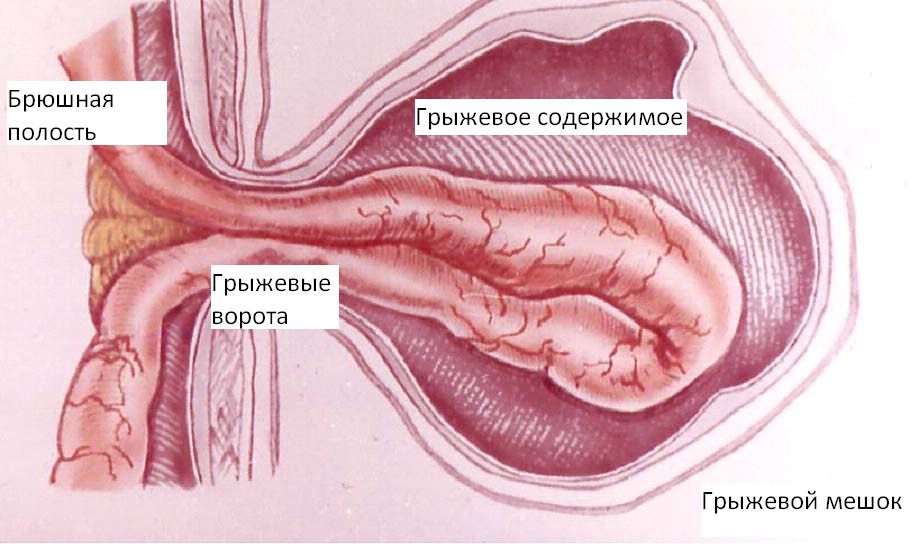 Ущемление грыжи