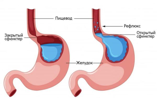 Рефлюкс-эзофагит