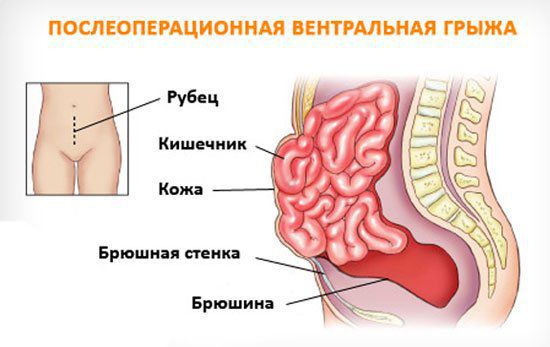 Послеоперационная вентральная грыжа