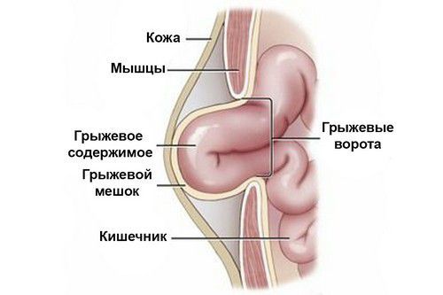 Анатомия вентральной грыжи