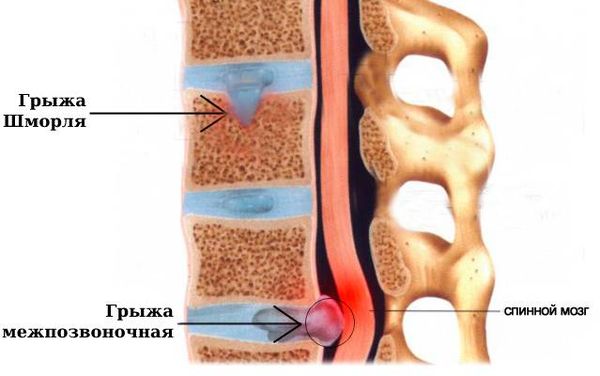 Грыжа Шморля и межпозвоночная грыжа