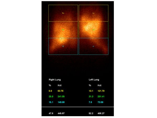 Сцинтиграмма пациента с ХОБЛ и диффузной эмфиземой