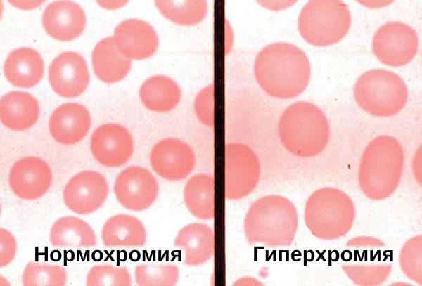 Гиперхромия