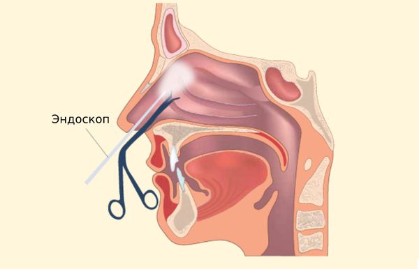 FESS (Functional Endoscopic Sinus Surgery)