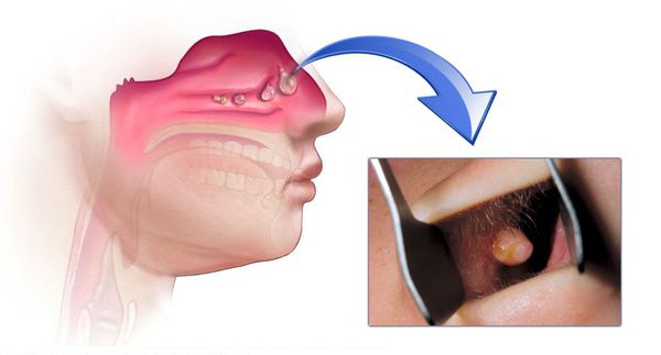 Полип в пазухе носа