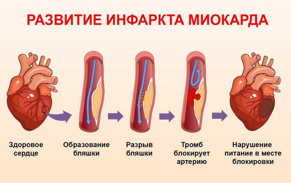 Развитие инфаркта миокарда