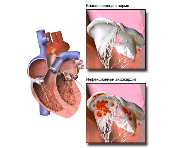 Инфекционный эндокардит