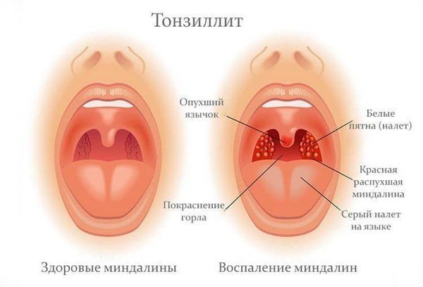 Тонзиллит