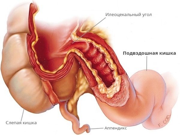 Илеоцекальный угол