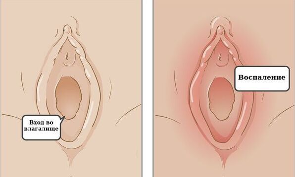 Воспаление и отёчность вульвы