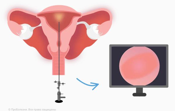 Гистероскопия
