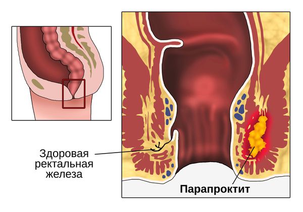 Острый парапроктит