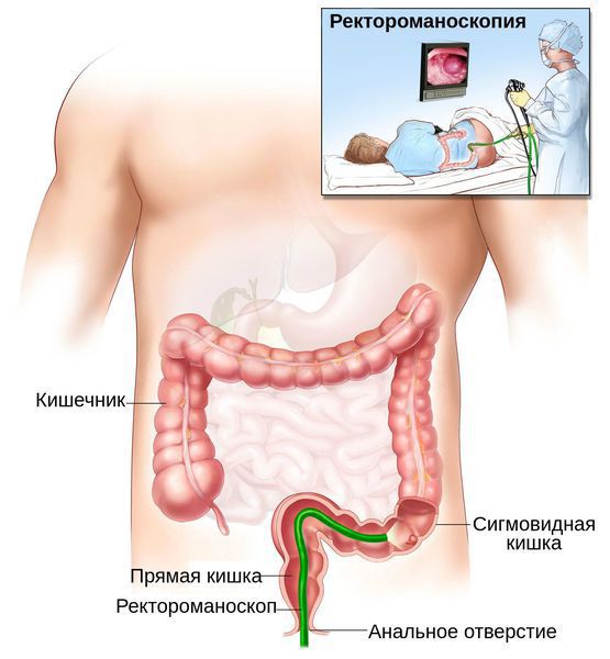 Ректороманоскопия